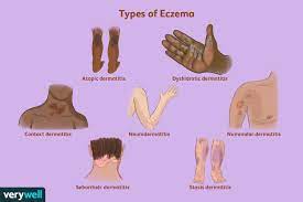 OMG There are SEVEN Types of Eczema!? - Real Blew Cosmetics