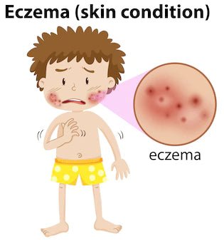 What is Eczema? Who does Eczema Affect? & How to Manage? - Real Blew Cosmetics